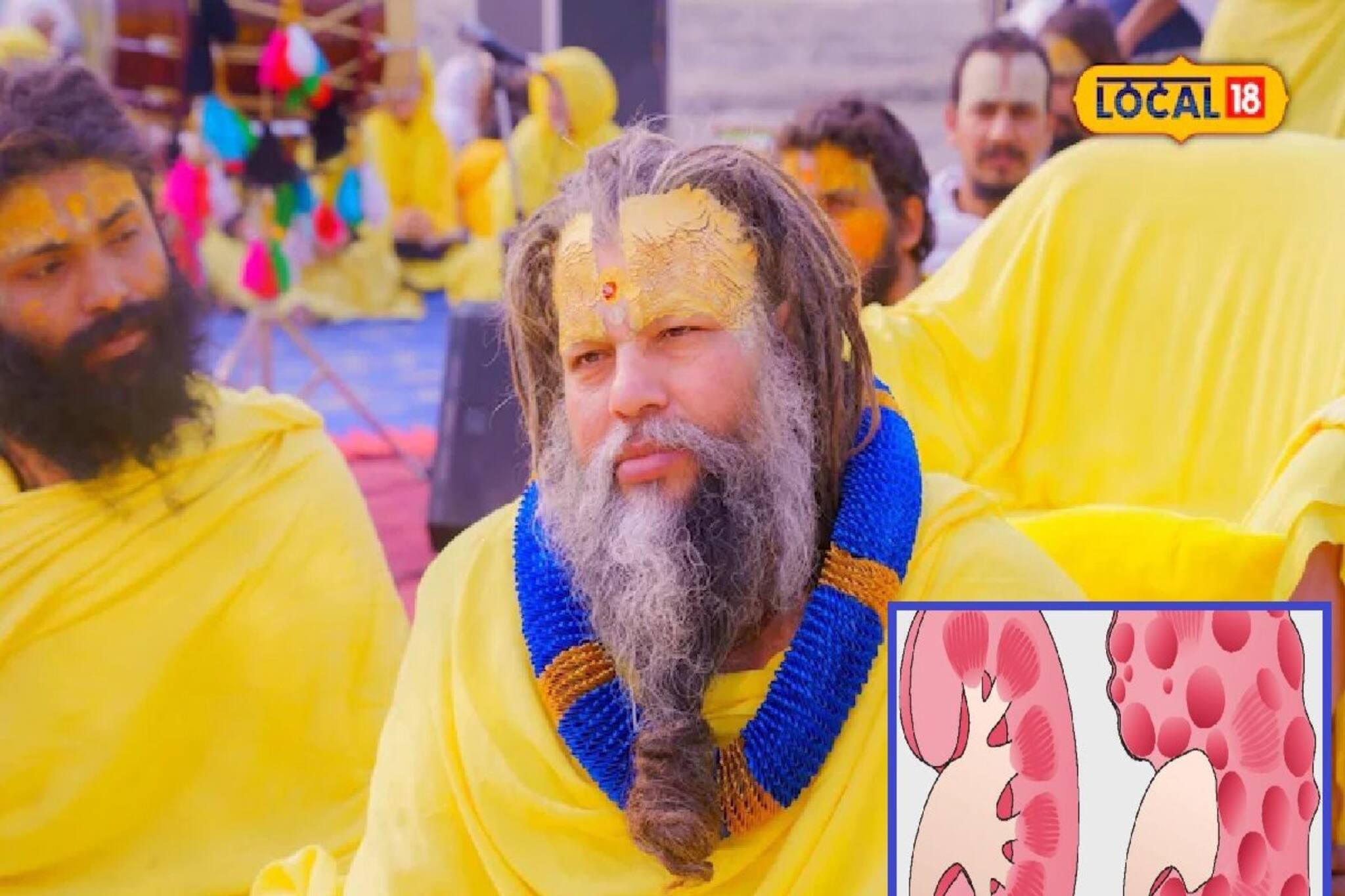 ADPKD- তে আক্রান্ত প্রেমানন্দ মহারাজ,এই মারণ রোগে ঠিক কীভাবে ক্ষতিগ্রস্ত হয় কিডনি,কেন হয়