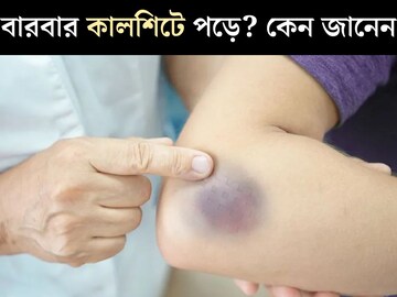 যেখানে সেখানে পড়ছে কালশিটে? কোন ভিটামিনের অভাবে হয় জানেন? কোনও বড় রোগের লক্ষণ নয় তো