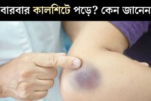 যেখানে সেখানে পড়ছে কালশিটে? কোন ভিটামিনের অভাবে হয় জানেন? কোনও বড় রোগের লক্ষণ নয় তো