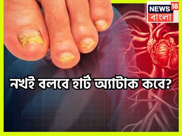 নখই বলবে হার্ট অ্যাটাক কবে! হালকা ভাবে নিলেই ভারী মূল্য চোকাতে হবে, যৌবনে বয়স্কদের মত রোগ