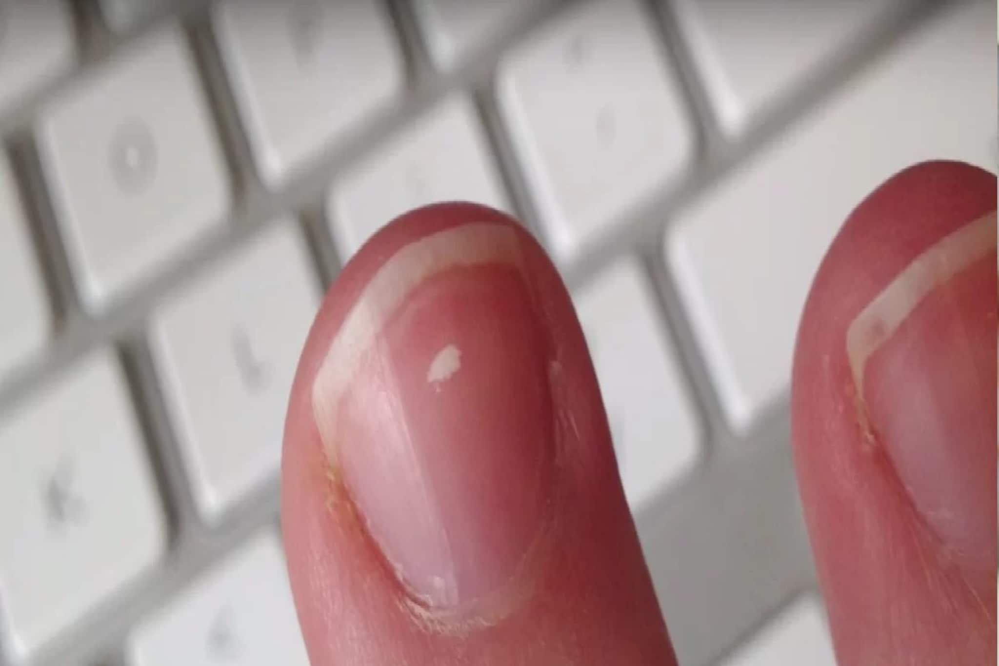 নখে সাদা দাগ হচ্ছে? শুধুই ক্যালসিয়ামের অভাব নয়, চিকিৎসকরা বলেছেন 'এটা' কারণ হতে পারে