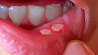 আলসারের প্রধান কারণ হল শরীরে ভিটামিন বি এবং আয়রনের অভাব