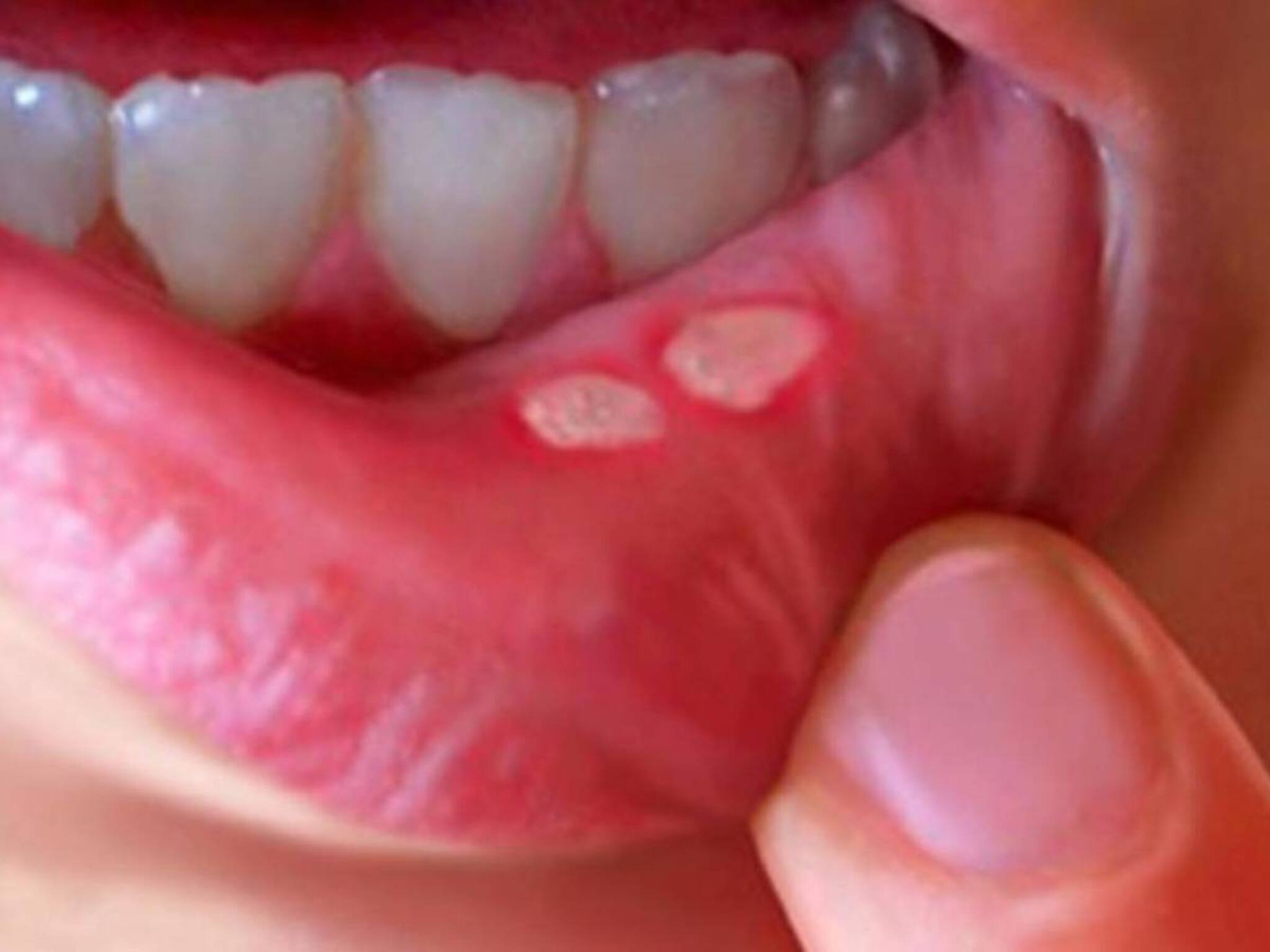 Mouth Ulcer Remedy: সবুজ ফল না অমৃত! গুঁড়ো করে জলে মিশিয়ে খেলেই সাফ মুখের ঘা! আরাম মাউথ আলসারের জ্বালাপোড়ায়