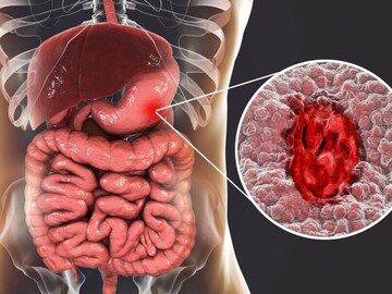 গ্যাস্ট্রিক ক্যানসারের লক্ষণ কী কী? বুঝবেন কীভাবে পাকস্থলীতে ক্যানসার হলে? জেনে নিন গ্যাস্ট্রিক ক্যানসারের লক্ষণ কী কী? বুঝবেন কীভাবে পাকস্থলীতে ক্যানসার হলে? জেনে নিন