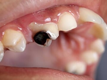 পোকা খাওয়া দাঁতের ব্যথায় চোখে জল? ‘এই’ পাতায় লবঙ্গ পুরে দিন ক্যাভিটিতে! কমবে যন্ত্রণা! পোকা খাওয়া দাঁতের ব্যথায় চোখে জল? ‘এই’ পাতায় লবঙ্গ পুরে দিন ক্যাভিটিতে! কমবে যন্ত্রণা!