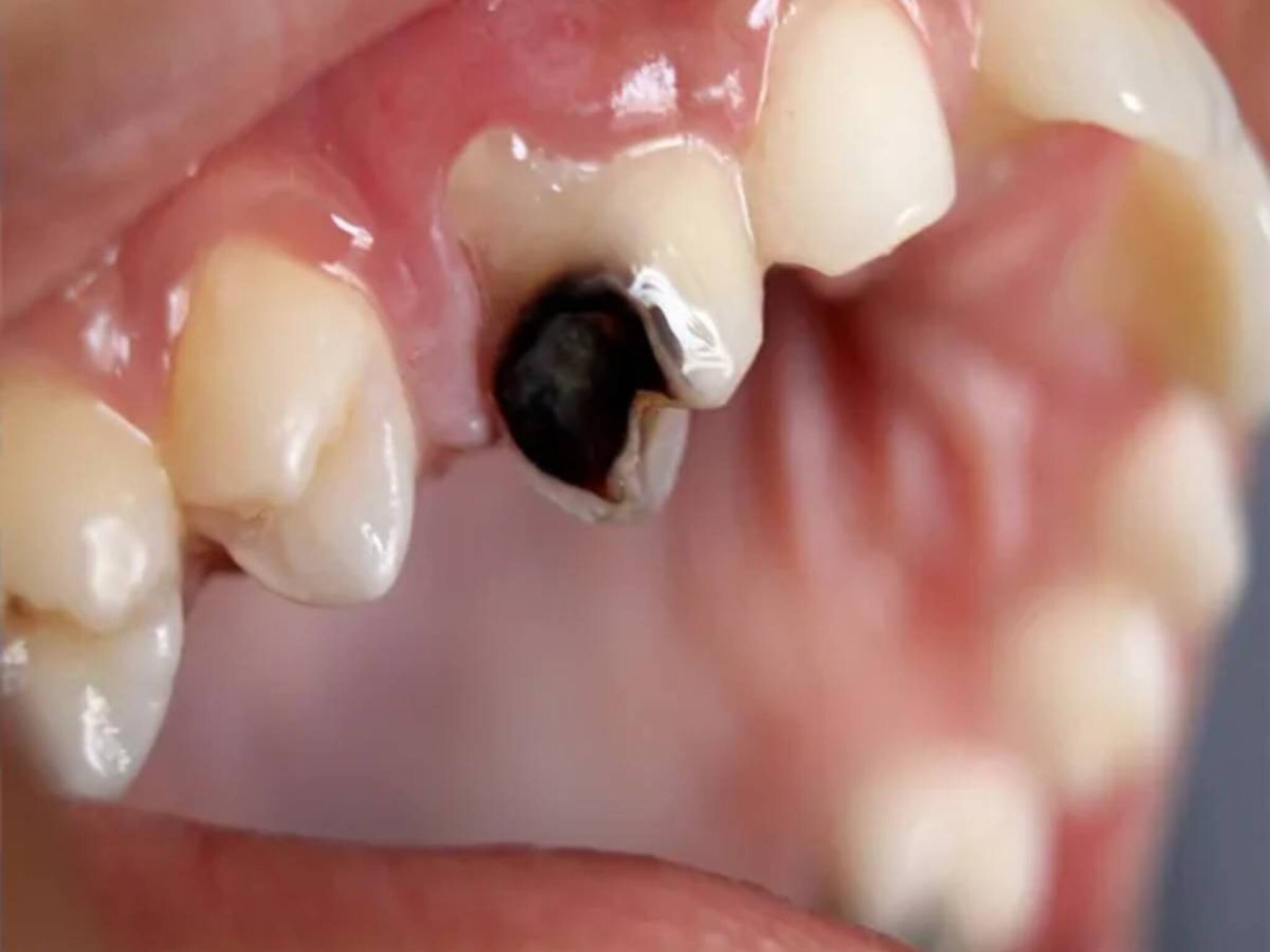 Tooth Problem: ফাঁপা হয়ে নড়বড় করে দাঁত! মুখ খুললেই পচা দুর্গন্ধ! সরষের তেলে ১ চিমটে এই মশলা দিয়ে মাড়ি পরিষ্কার করলেই ধুয়েমুছে সাফ ঘা!