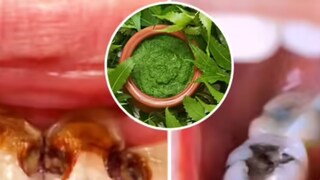 অতি সস্তার এই দুই জিনিস দিয়ে তৈরি করুন বিশেষ পেস্ট! জব্দ হবে পায়রিয়া, দূর হবে দাঁতের সব সমস্যা...