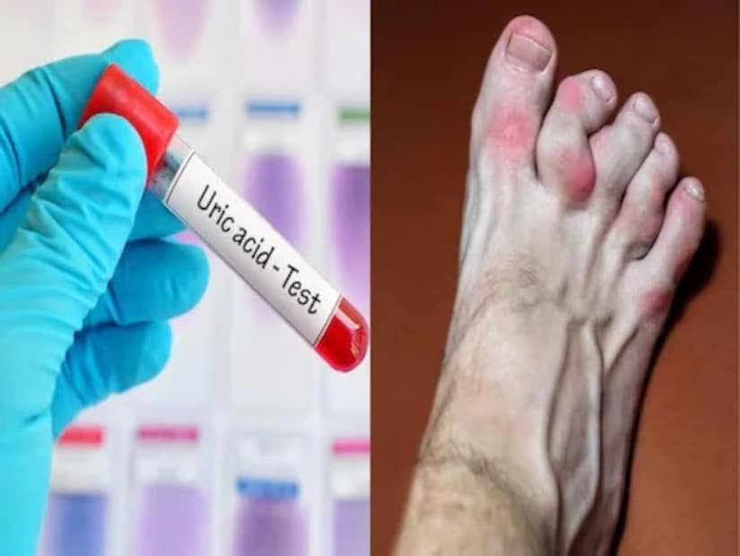 Uric Acid Control: ১ গ্লাস জলে জাস্ট হাফ চামচ! খেলেই ছাঁকনির মতো টেনে ধুয়েমুছে সাফ ইউরিক অ্যাসিড! নির্বংশ গাঁটের ব্যথা!