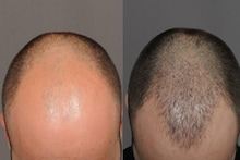Baldness Remedies: একবার টাক পড়ে গেলে আর কি নতুন চুল গজায়? বিশেষজ্ঞের কাছ থেকে সত্যিটা জানুন