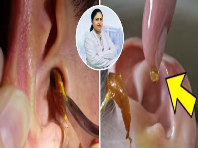 কার কানে বেশি ময়লা জমে?কারও কারও কানে খুব দ্রুত ময়লা জমে, তাই বছরে ৩–৪ বার ডাক্তার দিয়ে পরিষ্কার করাতে হয়। আবার অনেকের ক্ষেত্রে কোনও চিকিৎসারই দরকার হয় না। স্থায়ীভাবে ময়লা কমানোর বা বন্ধ করার কোনও উপায় নেই। নিজের থেকে ড্রপ বা ওষুধ ব্যবহার করলে বিপদ বাড়তে পারে। অতিরিক্ত ময়লা জমলে চাপ, শুনতে অসুবিধা বা কানে ব্যথা হতে পারে।