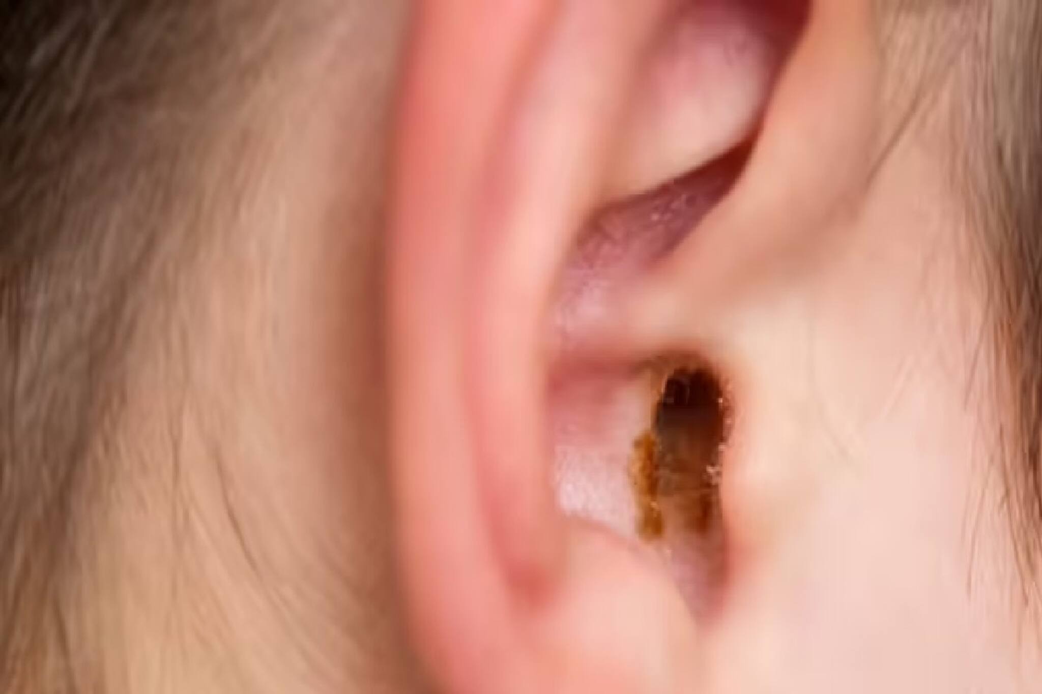 অল্প বয়সে কান হতে পারে খারাপ, শ্রবণশক্তি হারাতে পারেন... আপনার খাবারের তালিকার দিকে একবার