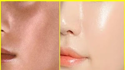 Beat Dark Circles: Home Remedies for Brighter Eyes