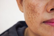 শীতে শুষ্ক, খসখসে ত্বক? মুখ ভর্তি দাগ-ছোপ? কসমেটিক্স নয়, একটু ফিটকিরিতেই ফিরবে গ্ল্যামার