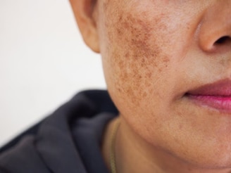 শীতে শুষ্ক, খসখসে ত্বক? মুখ ভর্তি দাগ-ছোপ? কসমেটিক্স নয়, একটু ফিটকিরিতেই ফিরবে গ্ল্যামার