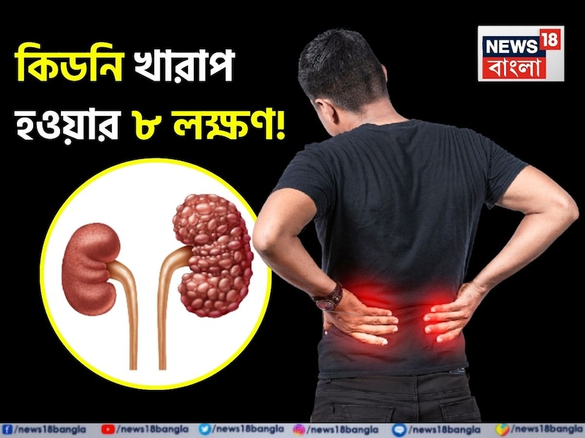 আজকের ব্যস্ত জীবনে কিডনি সম্পর্কিত সমস্যা দ্রুত বৃদ্ধি পাচ্ছে। বিশেষ করে তরুণরা এই সমস্যাগুলির শিকার হচ্ছে। কিডনি সম্পর্কিত রোগের প্রাথমিক লক্ষণগুলি এতটাই সাধারণ যে বেশিরভাগ মানুষ এগুলি চিনতে এবং উপেক্ষা করতে অক্ষম। যদি সময়মতো কিডনি সমস্যার চিকিৎসা না করা হয়, তাহলে এই সমস্যাগুলি কিডনির সার্বিক ব্যর্থতার দিকে নিয়ে যেতে পারে। তাই কিডনি সম্পর্কিত লক্ষণগুলি সম্পর্কে সকলের জানা উচিত। বলছেন বিশেষজ্ঞ গৌরব সাগর৷ 