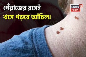 লাগবে না দামি ওষুধ! পেঁয়াজের রসেই খসে পড়বে আঁচিল! অস্বস্তি মুক্তির সেরা টোটকা!