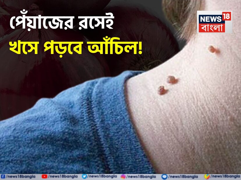 ত্বকের যে কোনও জায়গায় আঁচিল দেখা দিতে পারে। তবে বেশিরভাগ আঁচিল মুখ, হাত, পা, পেট এবং পিঠে দেখা যায়। তবে কিছু আঁচিল জন্ম থেকেই থাকে, যা কিছু মানুষ তাদের সৌন্দর্যের পথে বাধা হিসেবে বিবেচনা করে। তবে, কিছু মানুষের ক্ষেত্রে এই আঁচিল দেখতেও সুন্দর লাগে।