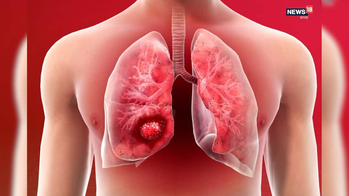 শুধু ধূমপান নয়, এই কয়েক অভ্যাসও গোপনে ফুসফুসের ক্ষতি করে! এখনই সচেতন না হলে কপালে দুঃখ আছে শুধু ধূমপান নয়, এই কয়েক অভ্যাসও গোপনে ফুসফুসের ক্ষতি করে! এখনই সচেতন না হলে কপালে দুঃখ আছে