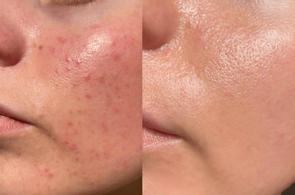 শুধু তাই নয়, এর ফলে অল্প বয়সে মুখে বয়সের ছাপ ও বলিরেখা দেখা দিতে পারে। এর বিরুদ্ধে লড়াই করার জন্য মানুষ অবশ্য আজকাল নানা ধরণের পদ্ধতি অবলম্বন করে থাকেন। কেউ কেউ দামি ফেসিয়াল বেছে নেন, আবার কেউ কেউ বাজারে পাওয়া বিভিন্ন সৌন্দর্য পণ্য ব্যবহার করতে শুরু করেন। কিন্তু এগুলো সবই ত্বকের উপর নেতিবাচক প্রভাব ফেলতে পারে।