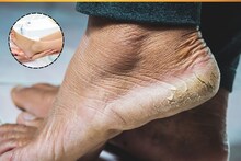 Cracked Heels Remedy: শীত আসতেই পা ফাটা শুরু হয়েছে তো? এই এক জিনিসেই পা হবে মসৃণ, এক পয়সাও খরচ হবে না