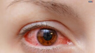 চোখের সমস‍্যা