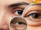 চোখের পাতা লাফাচ্ছে! অশুভ কিছু ঘটবে না তো? নাকি সৌভাগ্যে ভরবে জীবন! জানুন আসল কারণ