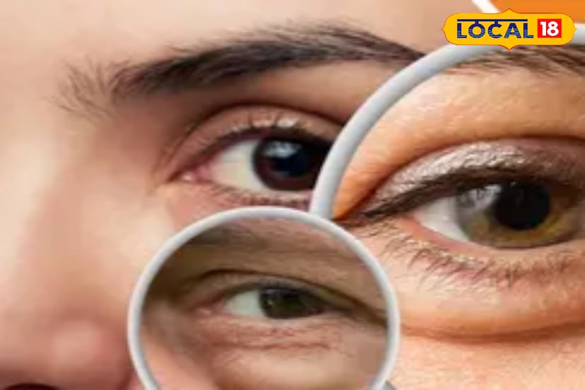আবার ছেলেদের ক্ষেত্রে ডান চোখ নাচলে বলা হয় যে ইচ্ছাপূরণ হতে চলেছে। শুভ-অশুভের বাছবিছারে আসল কারণটা জানারই চেষ্টা করেন না কেউ। এই চোখ নাচা বা লাফানোর সঙ্গে কিন্তু ভাগ্য বা দুর্ভাগ্যের কোনও সম্পর্কই নেই। আসল কারণটা পুরোপুরি স্বাস্থ্য বিষয়ক।