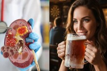 বিয়ার খেলেই গলবে কিডনির পাথর? নাকি মদ্যপানে ঝাঁঝরা কিডনি? জানুন ডাক্তারের মত