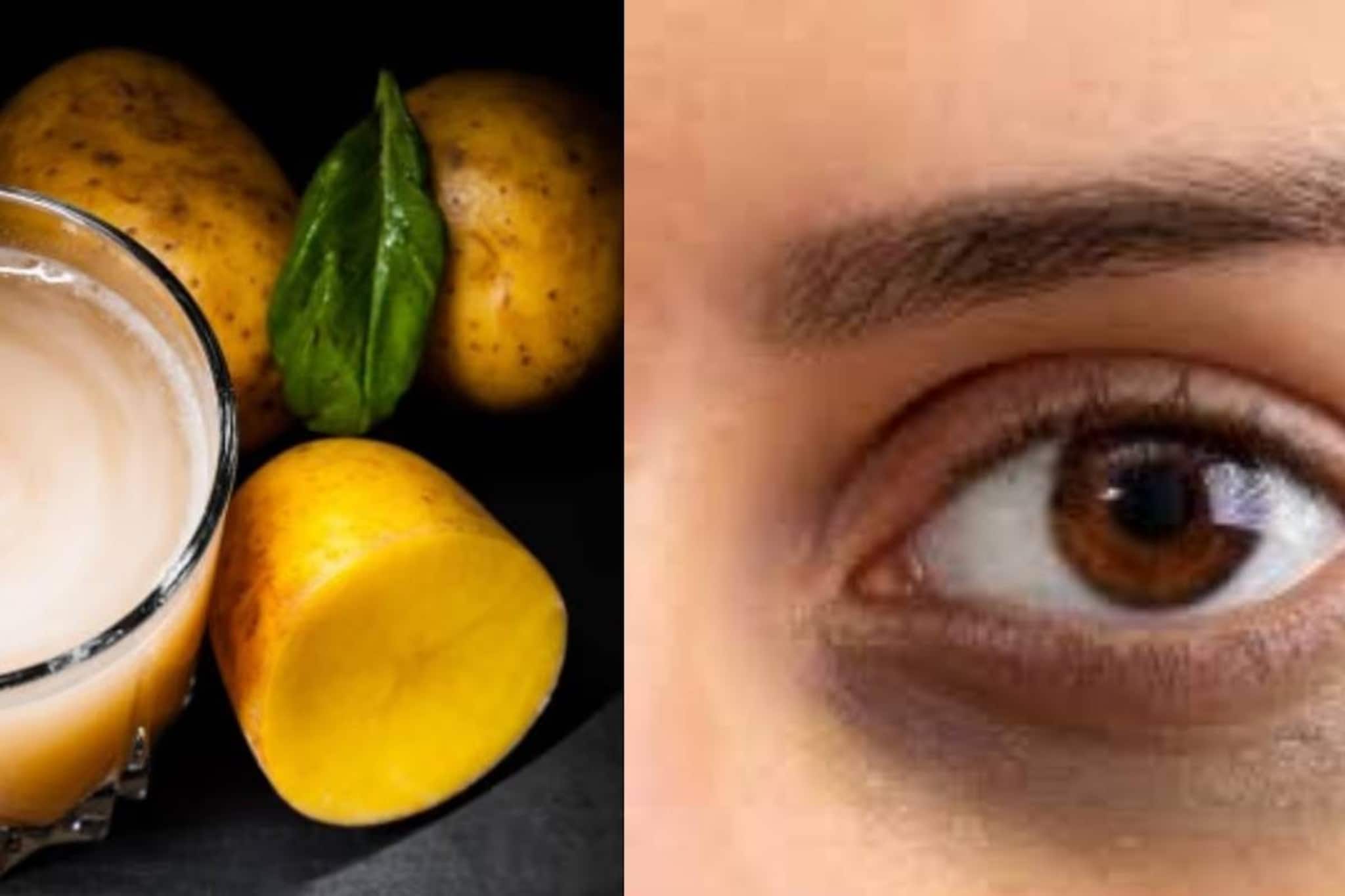 নামীদামি ক্রিম, লোশন গোল্লায় যাক! আলুর রসে ‘এটা’ মিশিয়ে লাগালেই উধাও হবে চোখের নীচের কালি