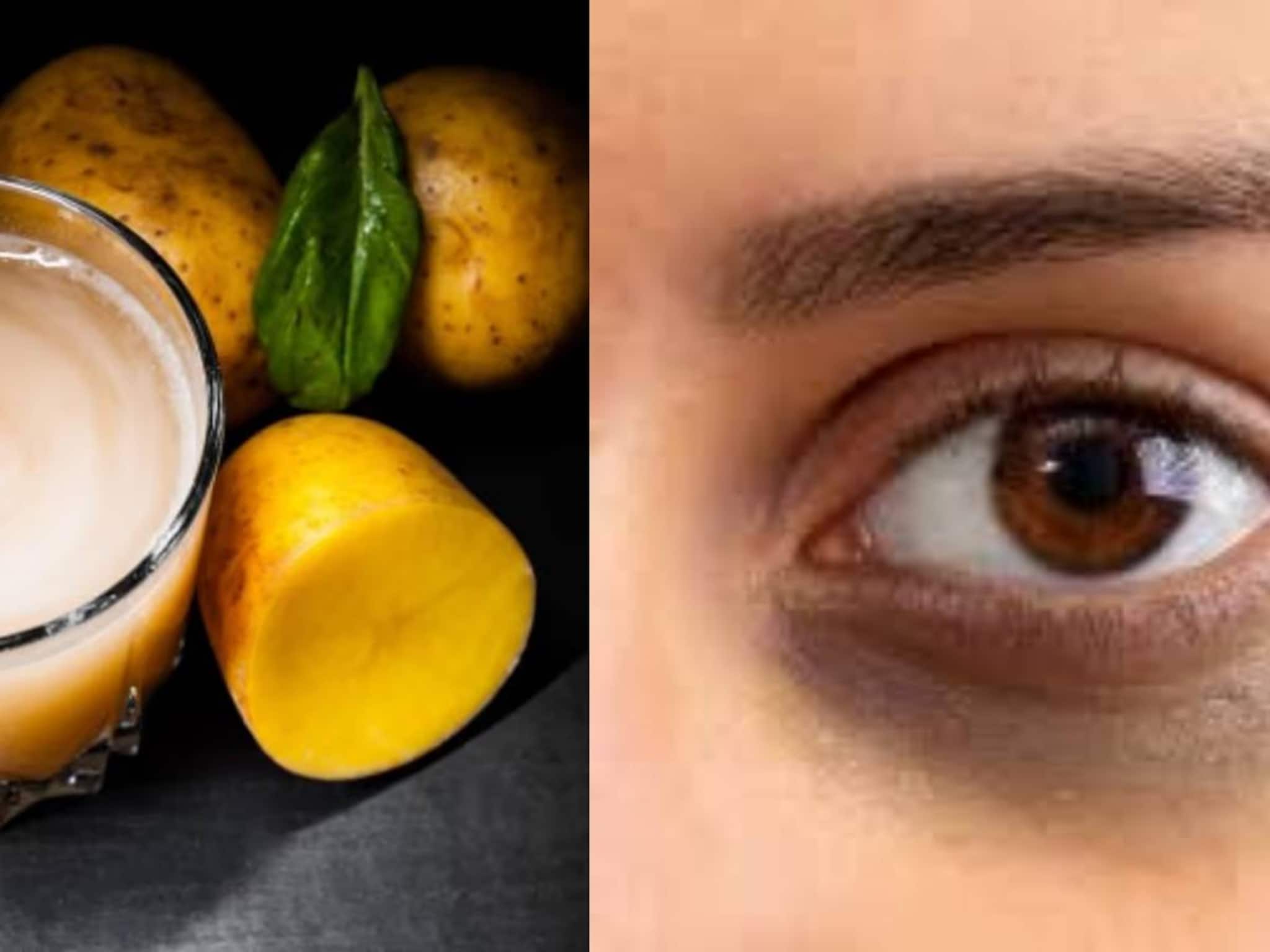 Undereye Dark Circles Home Remedies: নামীদামি ক্রিম, লোশন গোল্লায় যাক! আলুর রসে ‘এটা’ মিশিয়ে লাগালেই উধাও হবে চোখের নীচের কালি, কালো ছোপ!