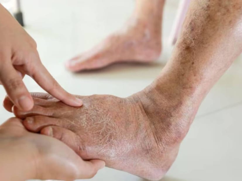 এমন পরিস্থিতিতে, এগুলি থেকে সংক্রমণ ছড়িয়ে পড়ার ঝুঁকি থাকে। পায়ে এই ধরনের ক্ষতকে ডায়াবেটিক ফুট আলসার বলা হয়। যদিও এটি নিরাময়ের জন্য বাজারে ওষুধ পাওয়া যায়, তবে আপনি বাড়িতেও এর জন্য ঘরোয়া টোটকা প্রয়োগ করতে পারেন। বলছেন বিশেষজ্ঞ আশুতোষ শাহ৷