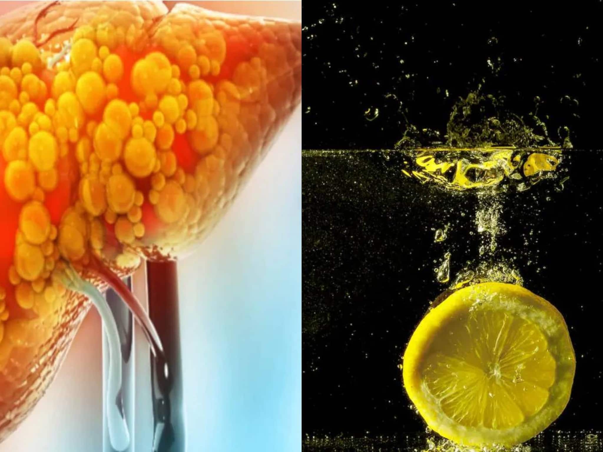 Fatty Liver Home Remedies: ১ চিমটে লেবুর রস আর মধু এভাবে খেলেই গলগলিয়ে সাফ লিভারের মেদ! ফ্যাটি লিভারের অলৌকিক আশীর্বাদ!