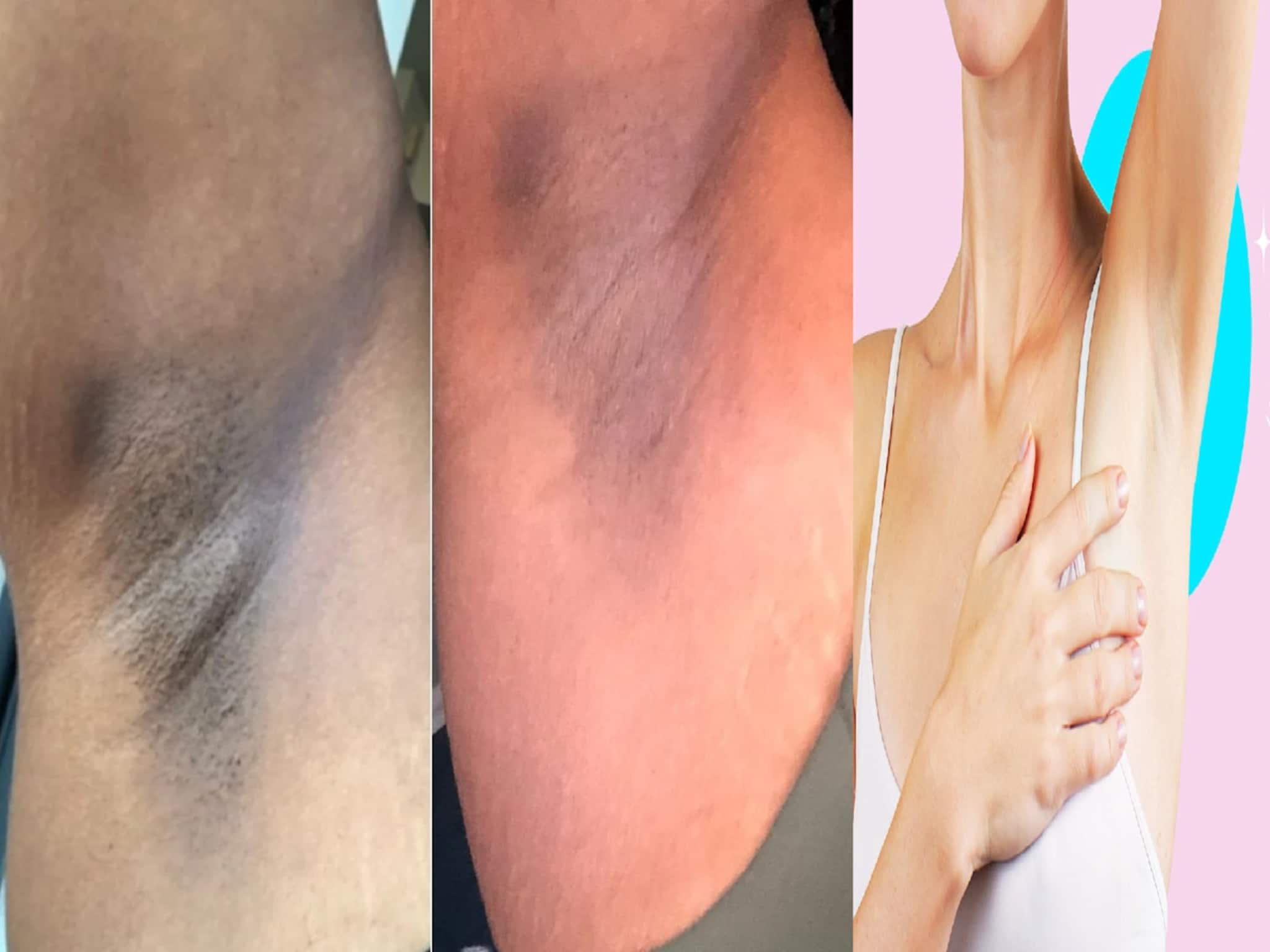 Dark Underarms Remedy: কালো বগল নিয়ে লজ্জায় পড়েন? ইচ্ছা হলেও স্লিভলেস পরতে পারেন না? বিনা খরচে, রান্নাঘরের ২ উপাদানে উধাও কালচে দাগ