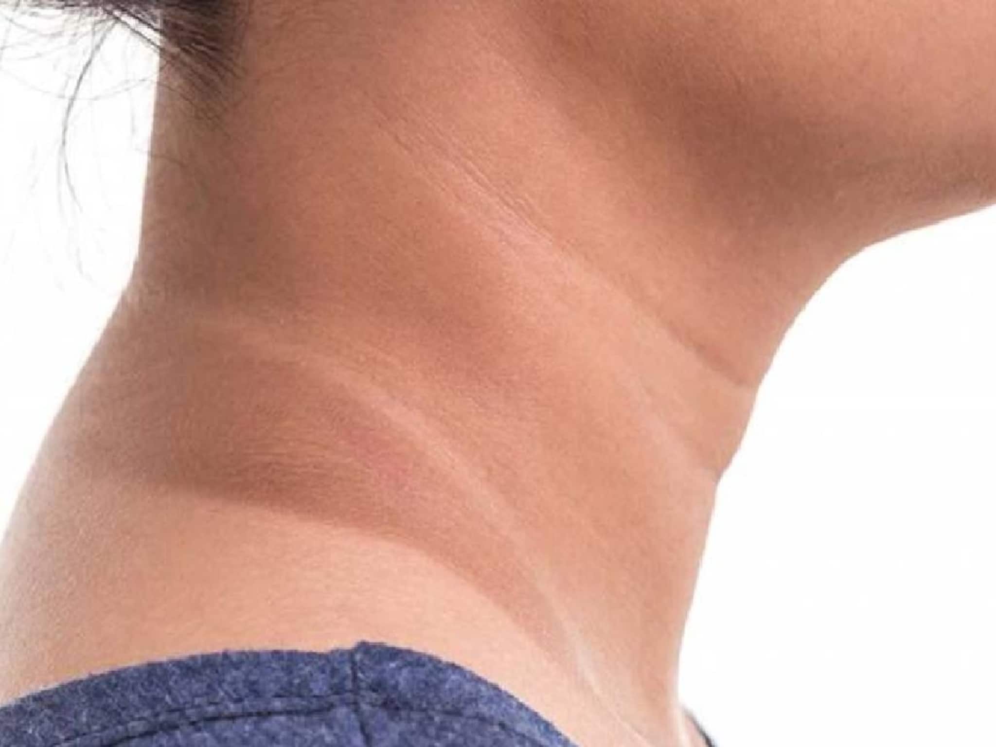 Get Rid Off Pigmentation: ঘাড়-গলায় কালো দাগ-ছোপ? কসমেটিক্স নয়, রান্নাঘরের ৪ উপকরণেই ঘাড় চকচক করবে, গায়েব সান-ট্যান,পিগমেন্টেশন
