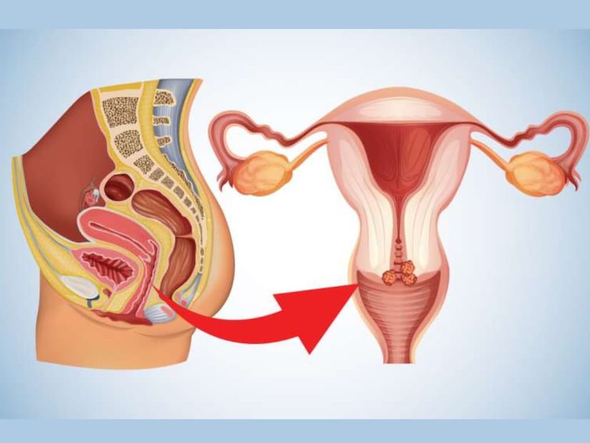 কীভাবে করা হয় পেপ টেস্টএই টেস্টে জরায়ুর গ্রীবা থেকে কোষকে বের করে এতে হওয়া পরিবর্তনের পরীক্ষা করা হয়। এই টেস্ট ডাক্তারদের ল্যাবে করা হয়। এটি একটু অস্বস্তিকর হতে পারে, কিন্তু দীর্ঘ সময় ধরে এর কারণে কোনও ব্যথা হয় না। 

