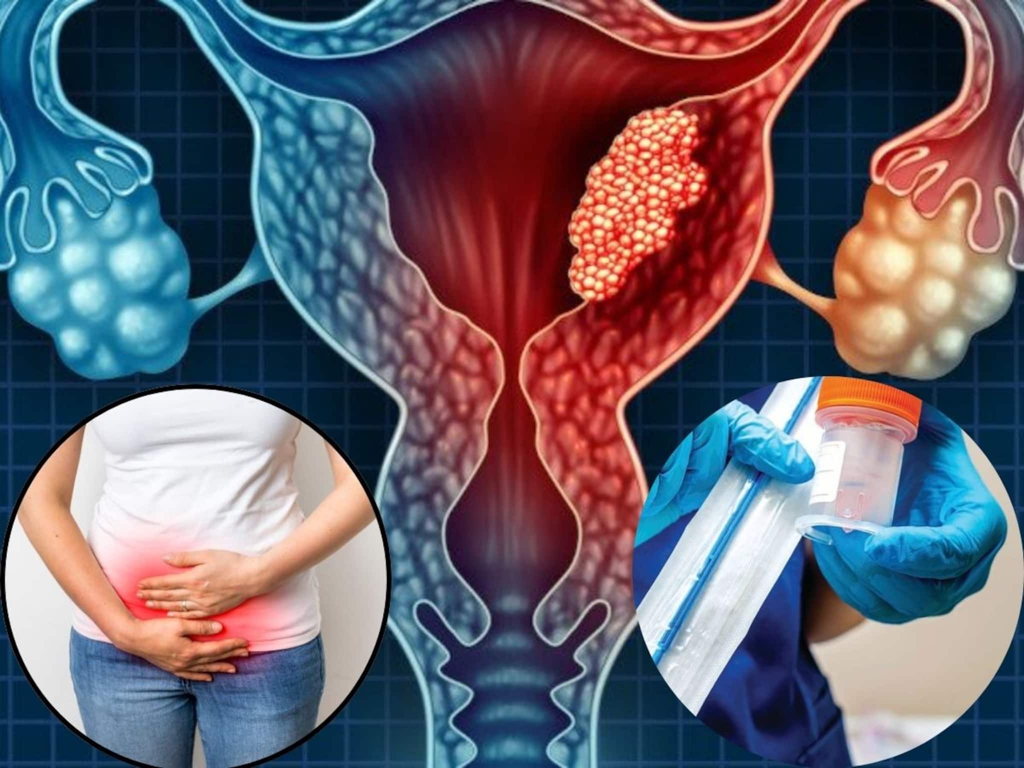 Cancer: শুধু পিরিয়ডস শেষে করুন ‘এটা’...মারণ সারভাইক্যাল ক্যানসার হবে ‘নির্মূল’! কীভাবে? পরামর্শ দিলেন চিকিত্‍সক