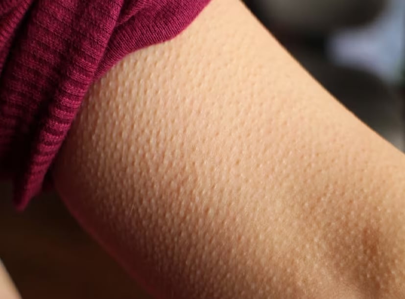 ইংরাজিতে একে বলে Goosebumps, বাংলায় বলে গায়ে কাঁটা দিচ্ছে! এই কাঁটা দেওয়ার ব্যাপারটা ঠিক কী? ত্বকের শান্তশিষ্ট রোমেরা আচমকাই বা কেন মাথা চাড়া দিয়ে ওঠে?  ইংরাজিতে একে বলে Goosebumps, বাংলায় বলে গায়ে কাঁটা দিচ্ছে! এই কাঁটা দেওয়ার ব্যাপারটা ঠিক কী? ত্বকের শান্তশিষ্ট রোমেরা আচমকাই বা কেন মাথা চাড়া দিয়ে ওঠে?