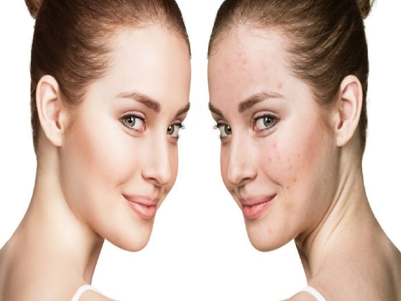 ব্রণ এবং ত্বক পরিষ্কারের জন্য: ফিটকিরির জল দিয়ে মুখ ধোয়া ছিদ্র পরিষ্কার করে, ব্রণ এবং ব্ল্যাকহেডস দূর করে এবং আপনার ত্বককে উজ্জ্বল করে। 