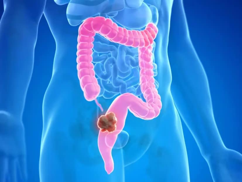 কোলাইটিস, আলসারের মতো সমস্যা থাকলেও কোলন ক্যানসারের আশঙ্কা বেশি থাকে৷