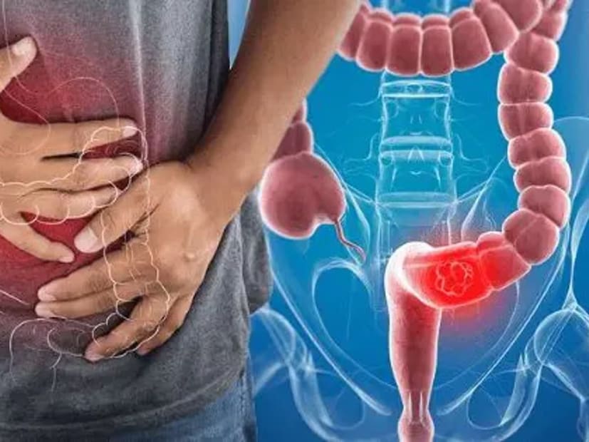 যাঁদের ডায়েটে প্রক্রিয়াজাত মাংস বা প্রক্রিয়াজাত অন্য খাবারের পরিমাণ বেশি এবং ফাইবারের অংশ কম, তাঁরাও কোলন ক্যানসারে আক্রান্ত হতে পারেন৷