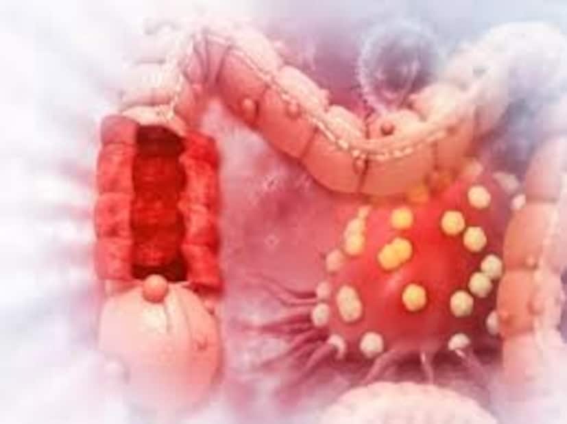 কাদের হতে পারে কোলন ক্যানসার? কয়েক জনের এই অসুখের ঝুঁকি বেশি৷ বয়স বেশি হওয়া এই রোগের বড় ঝুঁকি৷ বেশি বয়সে এই ক্যানসার হওয়ার আশঙ্কা বেশি৷ ৫০-৫৫ বছর বয়সিরা সতর্ক থাকুন৷