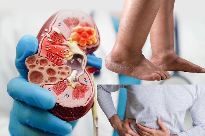 আয়ুর্বেদিক দৃষ্টিকোণ অনুসারে, কিডনির সমস্যা তিনটি দোষের ভারসাম্যহীনতার ফল। যখন বাত দোষ বৃদ্ধি পায়, তখন প্রস্রাবের প্রবাহ ব্যাহত হয়। পিত্ত দোষ বৃদ্ধি পেলে প্রস্রাবে জ্বালাপোড়া, ফোলাভাব বা রক্তের সৃষ্টি হতে পারে। কফ দোষ বৃদ্ধি পেলে শরীরে জল ধরে রাখার কারণ হয়, যার ফলে ফোলাভাব বা ভারী ভাব দেখা দেয়।