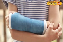 ভাঙা হাতে ভুল প্লাস্টারের মাশুল! প্রতিবন্ধী হয়ে পড়ল ৫ বছরের শিশু