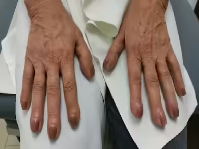 ফুসফুসের ক্যানসারের অন্যতম প্রাথমিক উপসর্গ হল ফিঙ্গার ক্লাবিং বা ডিজিটাল ক্লাবিং। এক্ষেত্রে আঙুলের ডগা ফুলে যায় এবং নখের আকৃতিতে বিশেষ পরিবর্তন দেখা যায়। এই পরিস্থিতি একদিনে হয় না! ধীরে ধীরে হয়। কাজেই, প্রাথমিক পর্যায়ে তা বোঝা কঠিন। 
