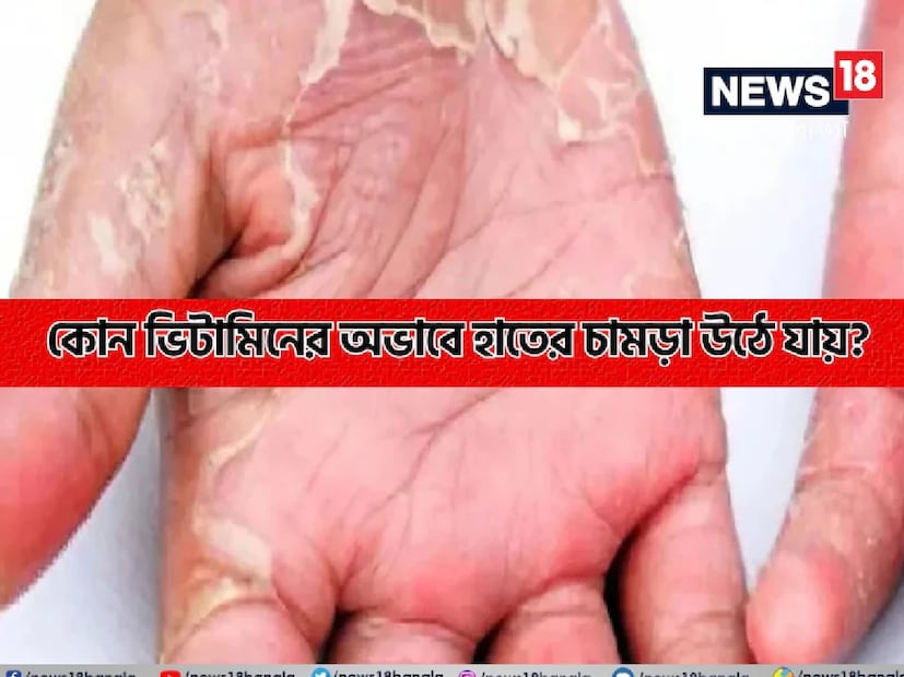 ভিটামিন ই (Vitamin E)ত্বকের রক্ষাকবচ হিসেবে কাজ করে। এটি ত্বককে মসৃণ রাখে ও মৃত কোষের পুনর্জন্ম ঘটায়। এর অভাবে ত্বক খসখসে হয়ে ছাল উঠতে পারে।
&#x1f449; উৎস: তৈলাক্ত মাছ, আভোকাডো, বাদাম, সূর্যমুখী তেল, অঙ্কুরিত শস্য।