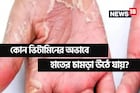 হাতে-পায়ে চামড়া উঠছে? শরীরে 'বিপদ' সংকেত! জেনে নিন কোন ভিটামিনের অভাবে এমনটা হয় 