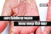 হাতে-পায়ে চামড়া উঠছে? শরীরে 'বিপদ' সংকেত! জেনে নিন কোন ভিটামিনের অভাবে এমনটা হয় 