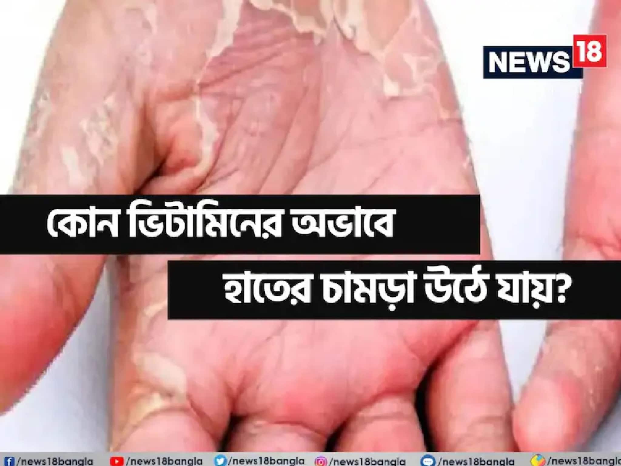হাতে-পায়ে চামড়া উঠছে? শরীরে 'বিপদ' সংকেত! জেনে নিন কোন ভিটামিনের অভাবে এমনটা হয় 