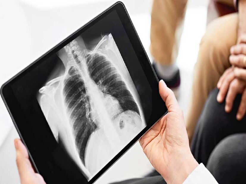 পাশাপাশি, বাতাসে ভাসমান বিষাক্ত কণা থেকে ফুসফুসকে রক্ষাও করতে পারে। সিওপিডি, হাঁপানি বা ফুসফুসের সংক্রমণ যাঁদের রয়েছে, তাঁরা এই টিকা নিয়ে রাখলে জটিল অসুখের হাত থেকে বাঁচতে পারেন। তবে টিকা নেওয়ার আগে অবশ্যই চিকিৎসকের পরামর্শ নিতে হবে। 