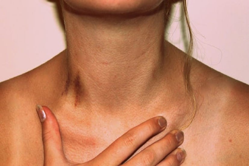 অনেকের শরীরে আয়রন কম থাকলে রক্তপ্রবাহ বাধা পেতে পারে৷ সেই পরিস্থিতিতে যদি তাঁদের শরীরে লাভ বাইট দেখা দেয়, সেক্ষেত্রে দাগ মিলিয়ে যেতে সময় লাগবে৷ অনেক সময়েই লভ বাইট বিপজ্জনক হয়ে দেখা দেয়৷ শরীরের একটি ক্ষুদ্র ধমনীও যদি বাধা পায়, তাহলে স্ট্রোকের আশঙ্কা বেড়ে যায়৷ (প্রতীকী ছবি)